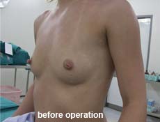 plastic-surgery-breast-augmentation 